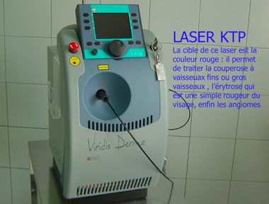 laser ktp